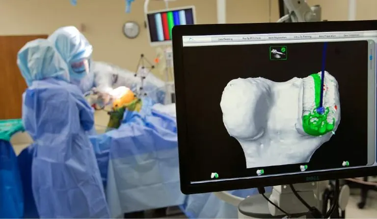 Mako robotic partial knee replacement in theatre, the knee model on the planning screen
