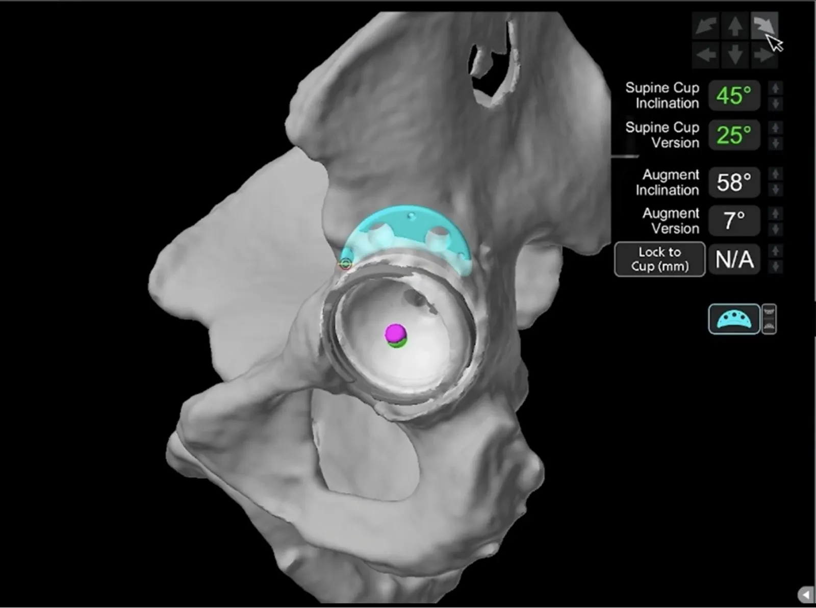 Mako planning screen: acetabular component and augment planning