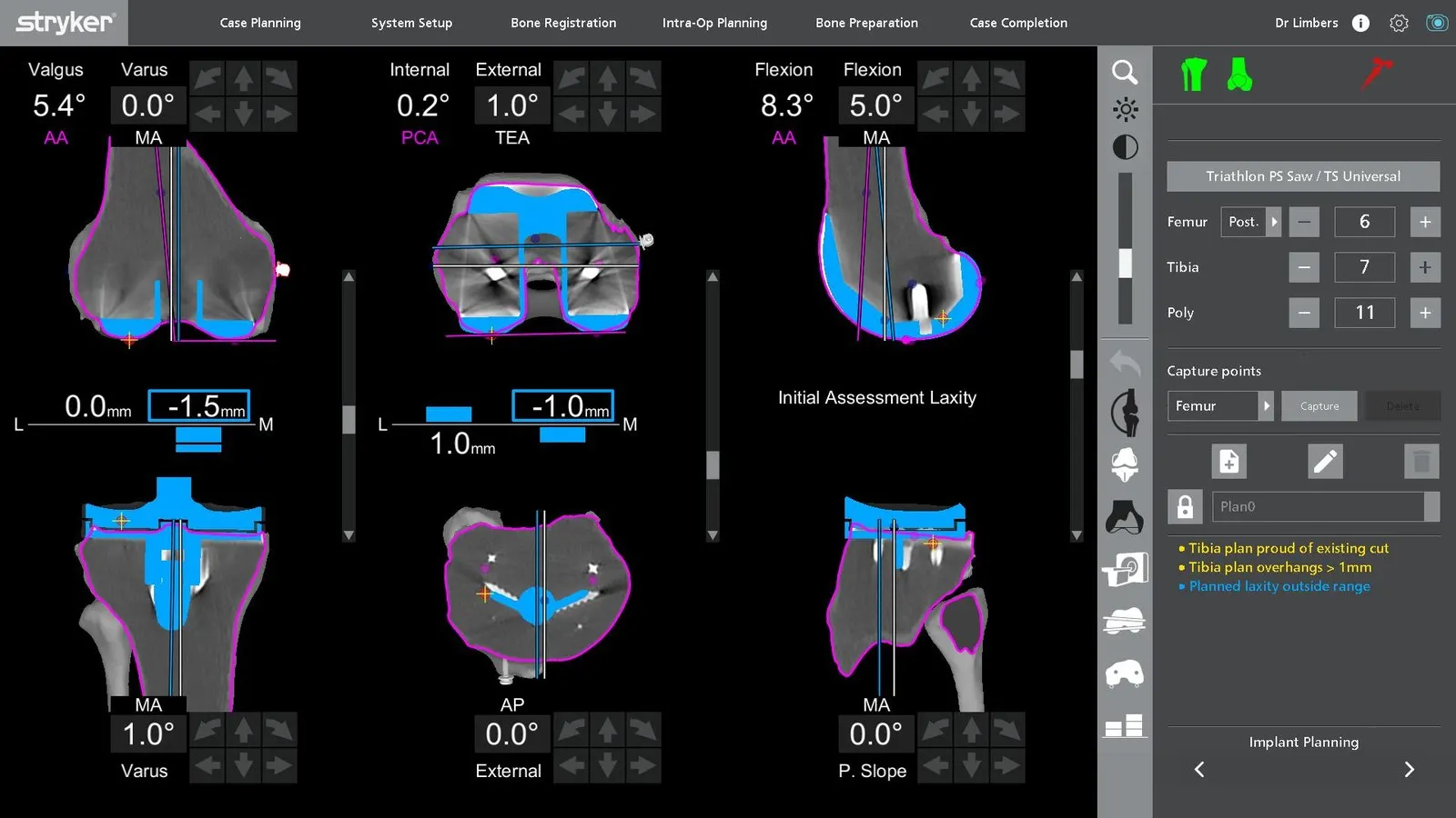 Mako planning screen: final knee laxity values