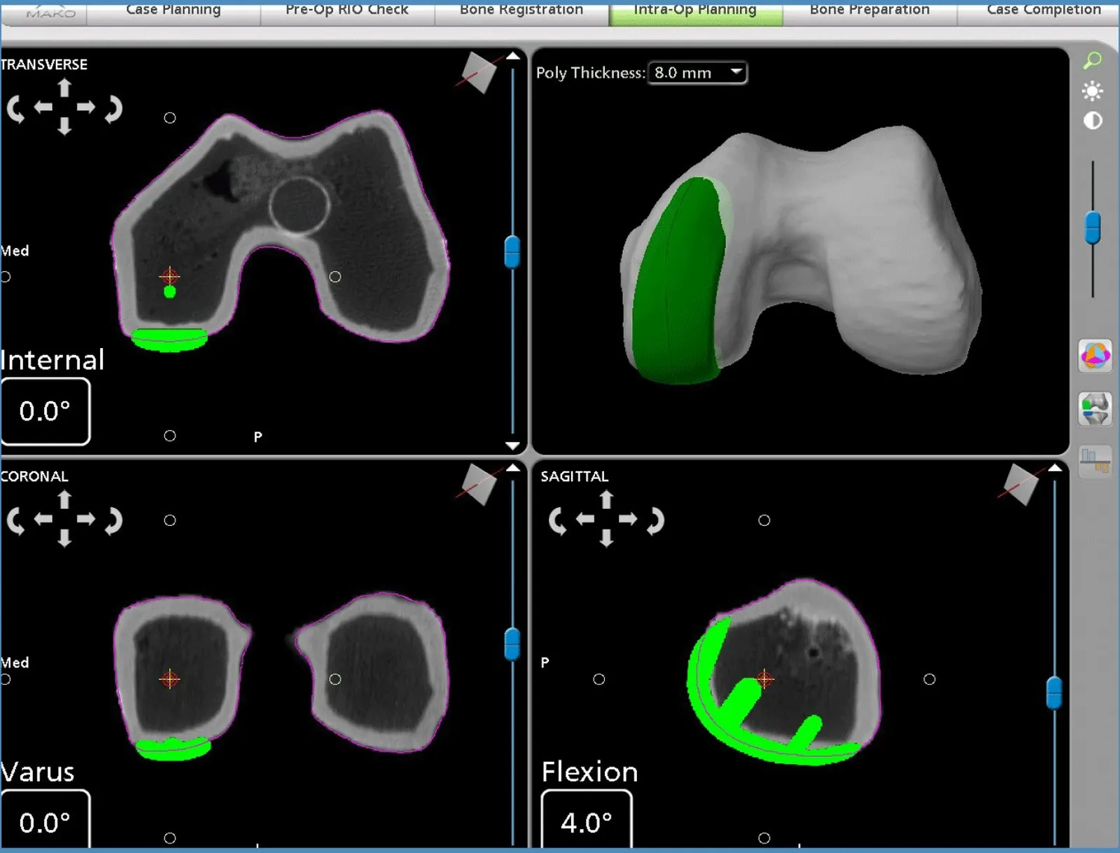 Mako planning screen: partial knee replacement, with the single compartment to be resurfaced