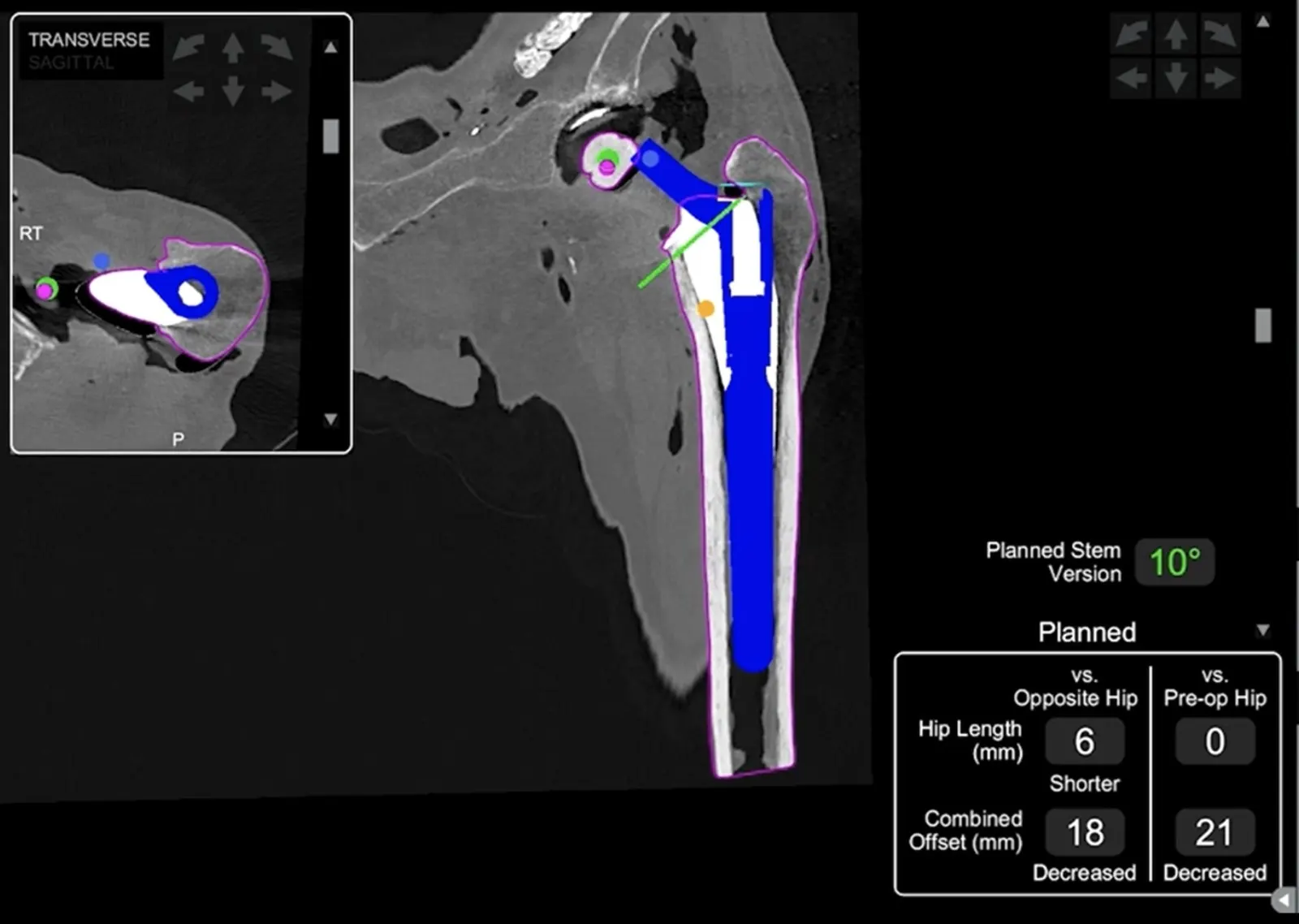 Mako planning screen: femoral component planning