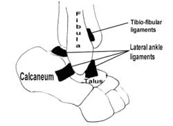 Ankle Ligament Injuries - Dr John Limbers