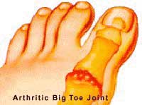 Osteoarthritis in Big Toe: Causes, Symptoms, and Pain Relief