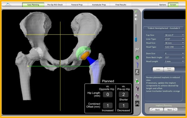 Optimised positioning system (OPS) in total hip replacement